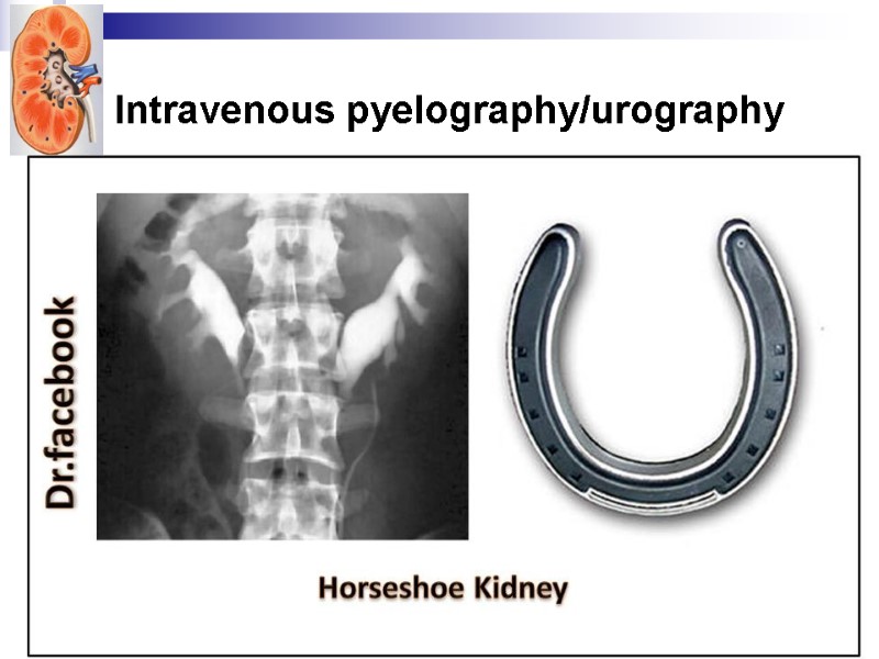Intravenous pyelography/urography